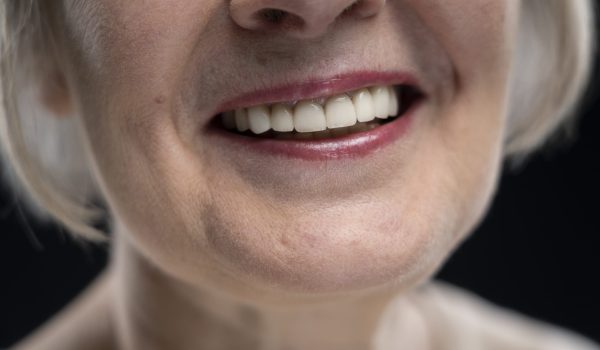 implantes-dentales-min implantes-dentales-min